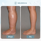Neurovia™ EMS aktivátor nohou pro nateklé, těžké nebo oslabené nohy – pro domácí použití