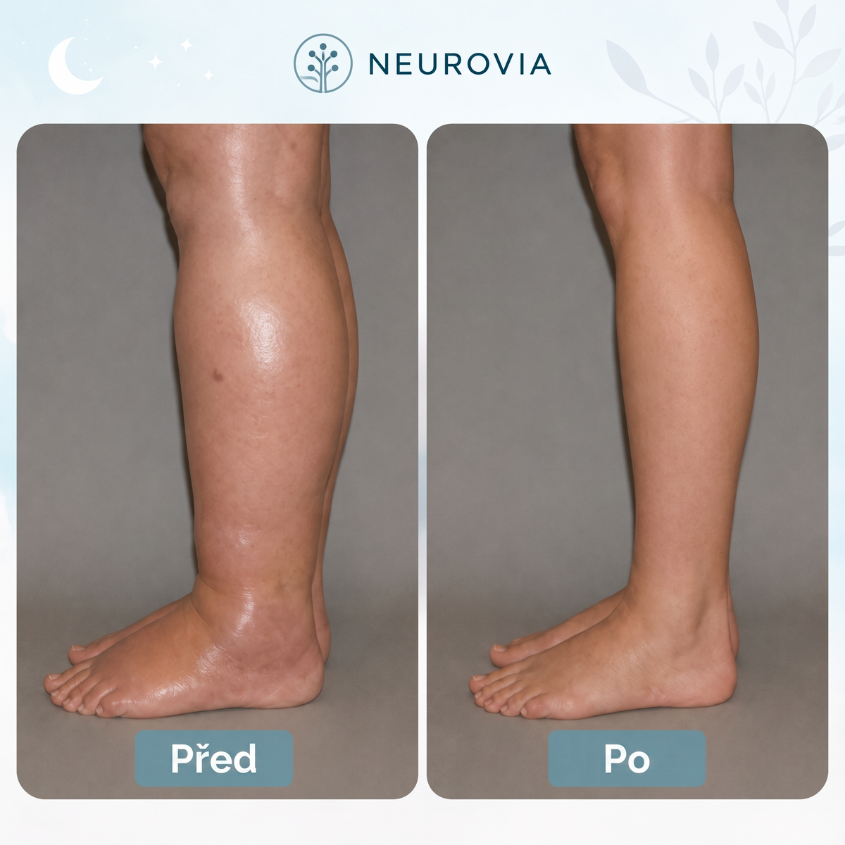 Neurovia™ EMS aktivátor nohou pro nateklé, těžké nebo oslabené nohy – pro domácí použití